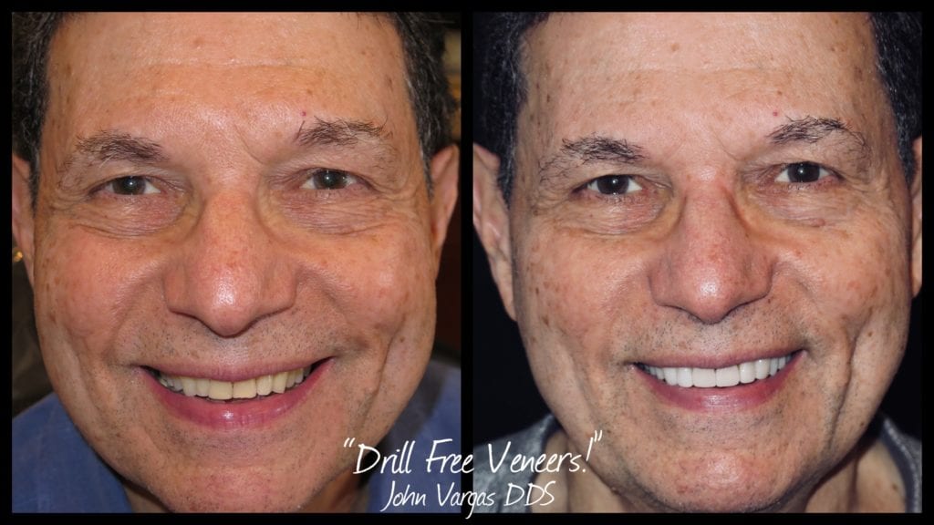 Before & After photo of no-drill veneers by Dr. John Vargas