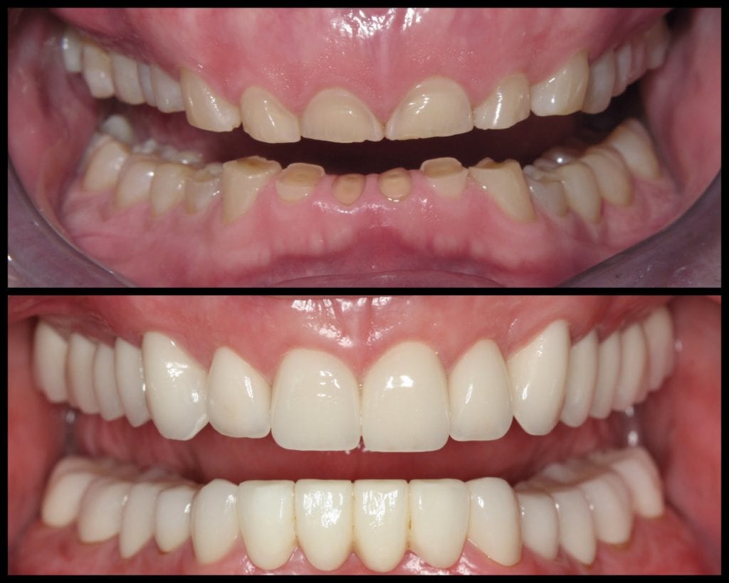 Worn teeth before & after by Chappaqua Smiles
