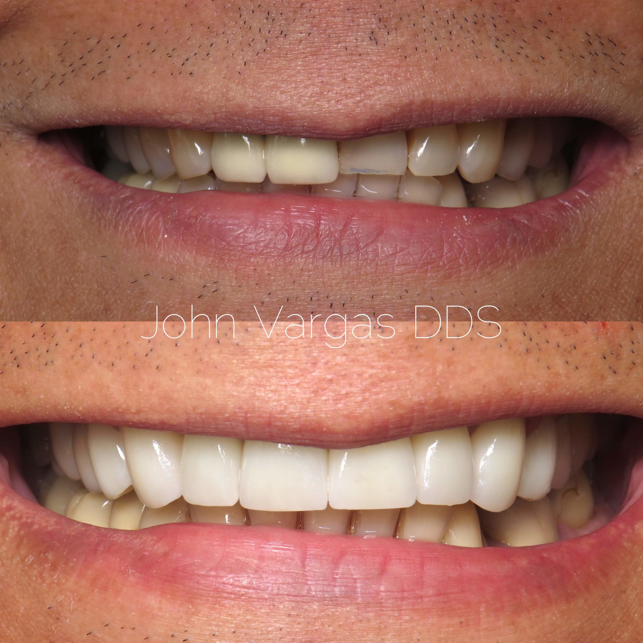 Veneers before and after by Chappaqua Smiles