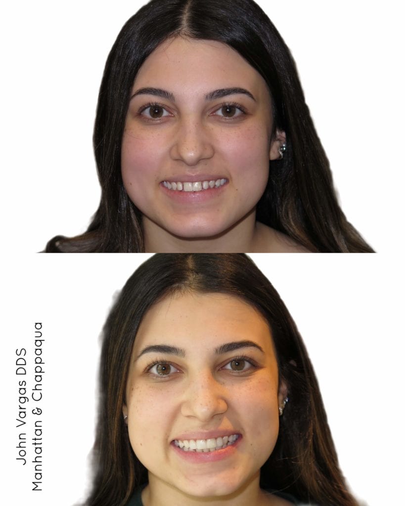 Composite veneers before and after