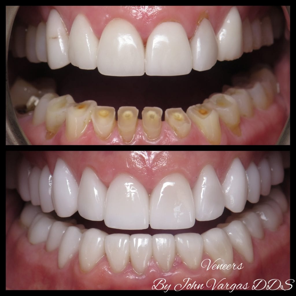 Worn teeth before & after by Chappaqua Smiles