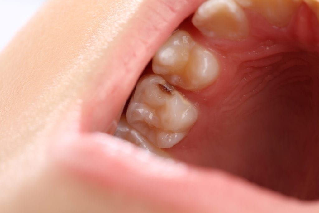 close-up of tooth cavity