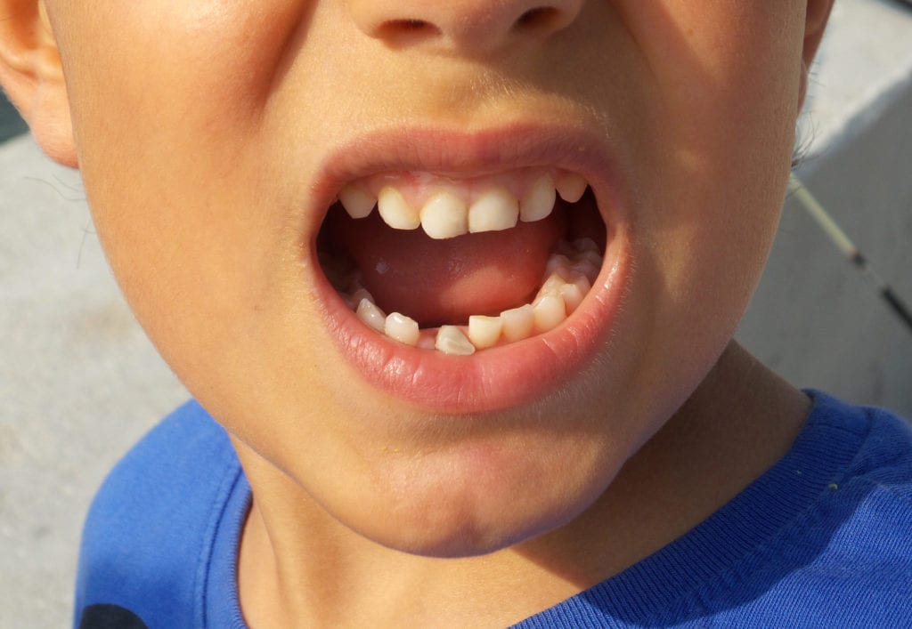Child missing teeth